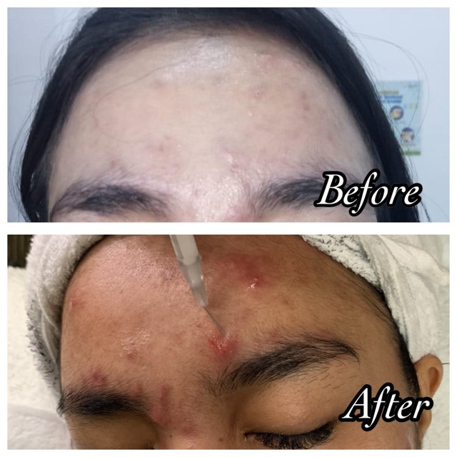 Acne Injection : Patient of Riyena Orthomedik