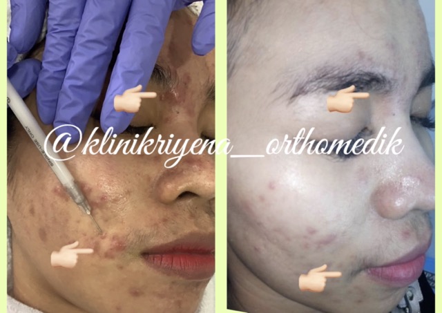 Acne Injection : Patient of Riyena Orthomedik
