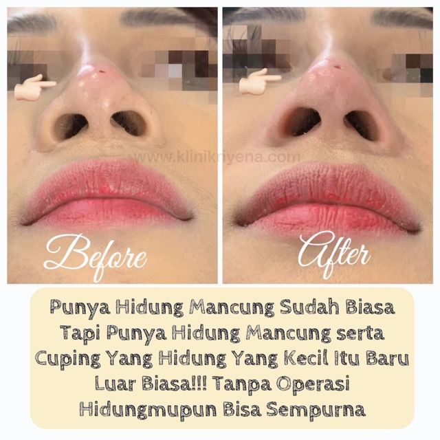 Nose Filler : Patient of Riyena Orthomedik