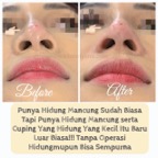 fillerbenang_hidung_testi2.jpg