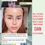 fillerbibir_ invasif_mesoV_testi.jpg